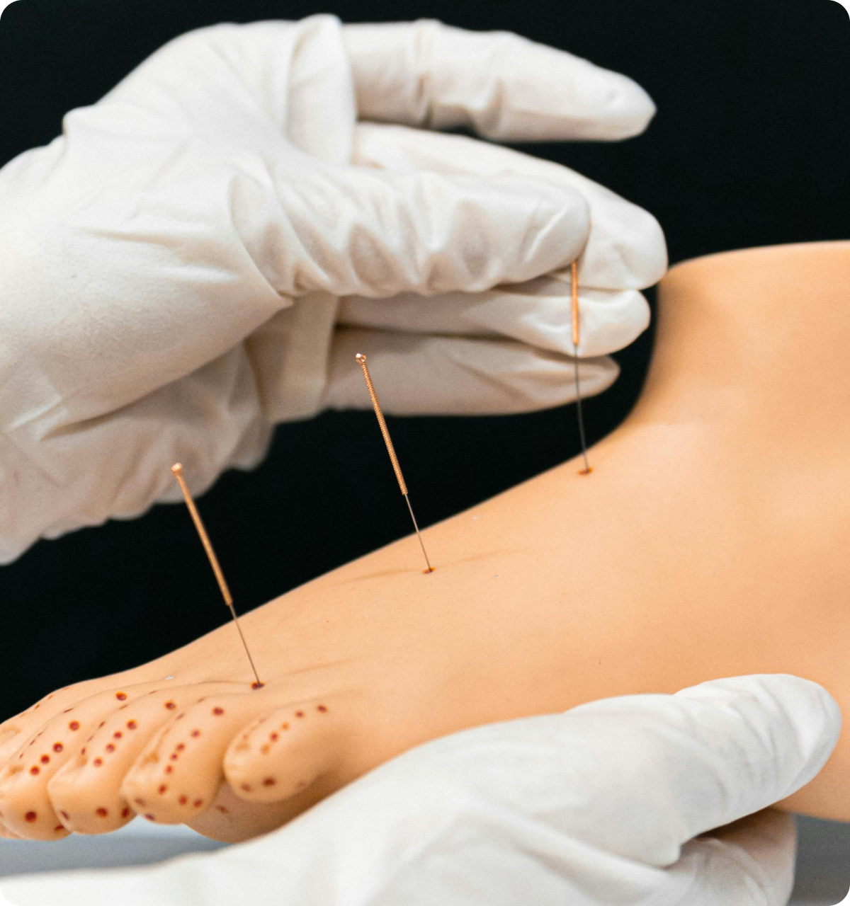 Musculoskeletal treatment with dry needling